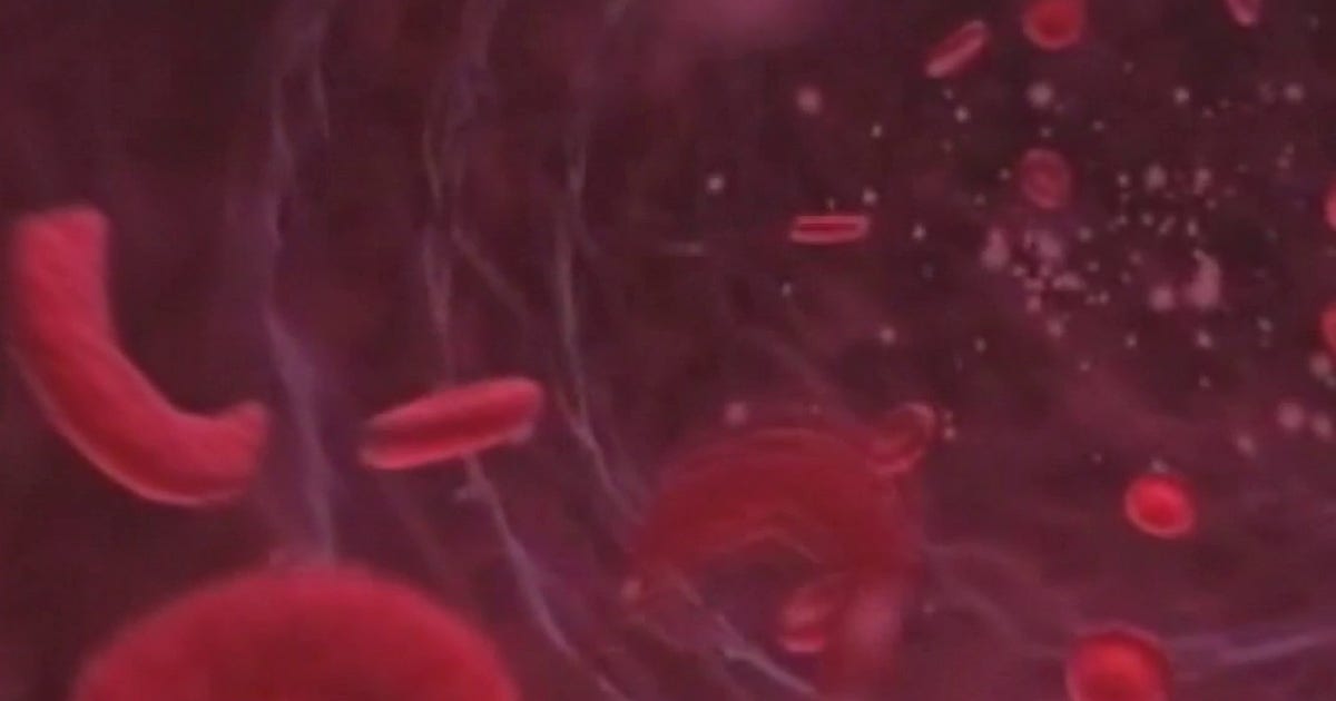 First Michigan Patient Receives Groundbreaking Gene Therapy for Sickle Cell