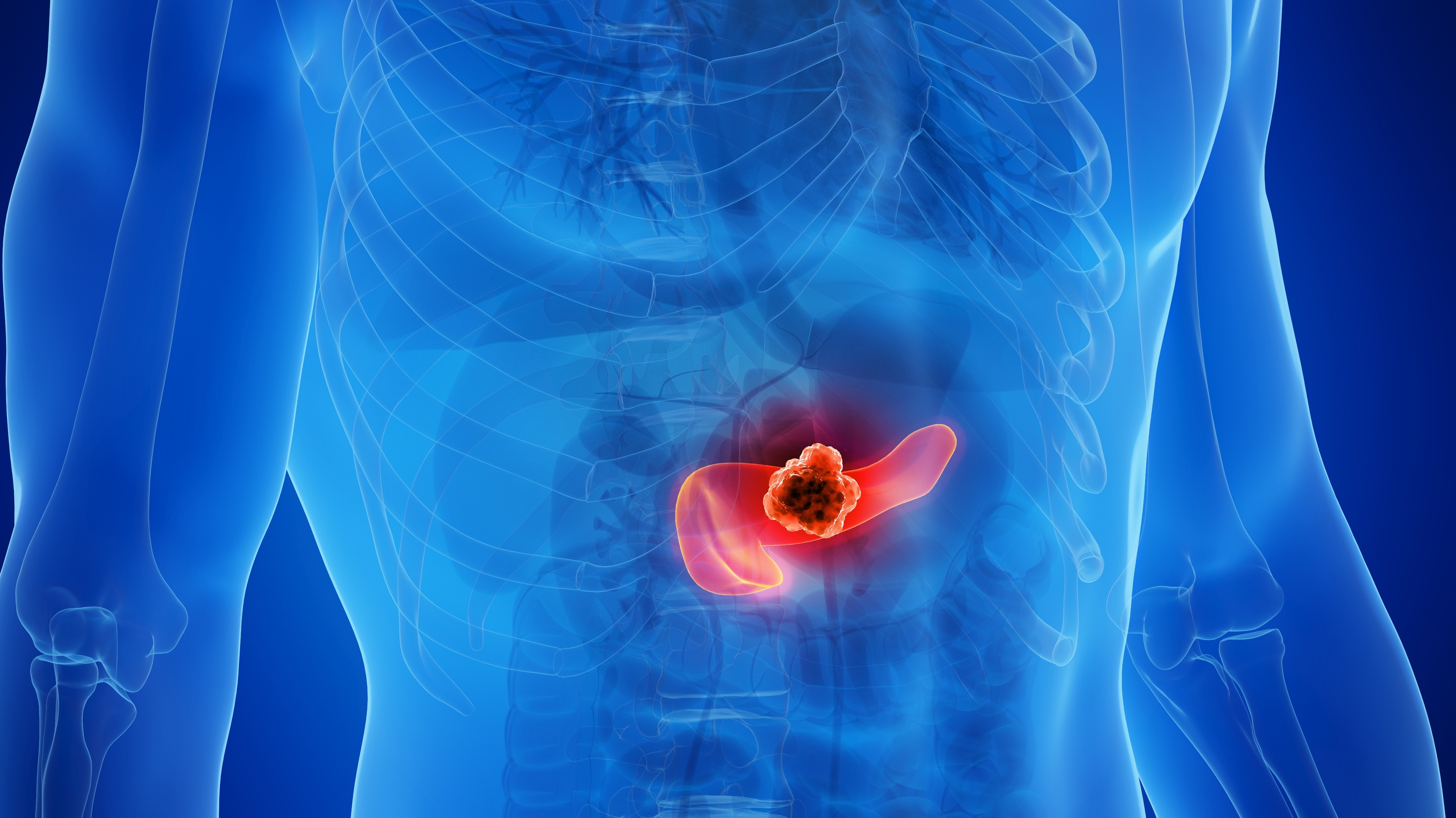 Triple Drug Combo Overcomes Treatment Resistance in Pancreatic Cancer Models