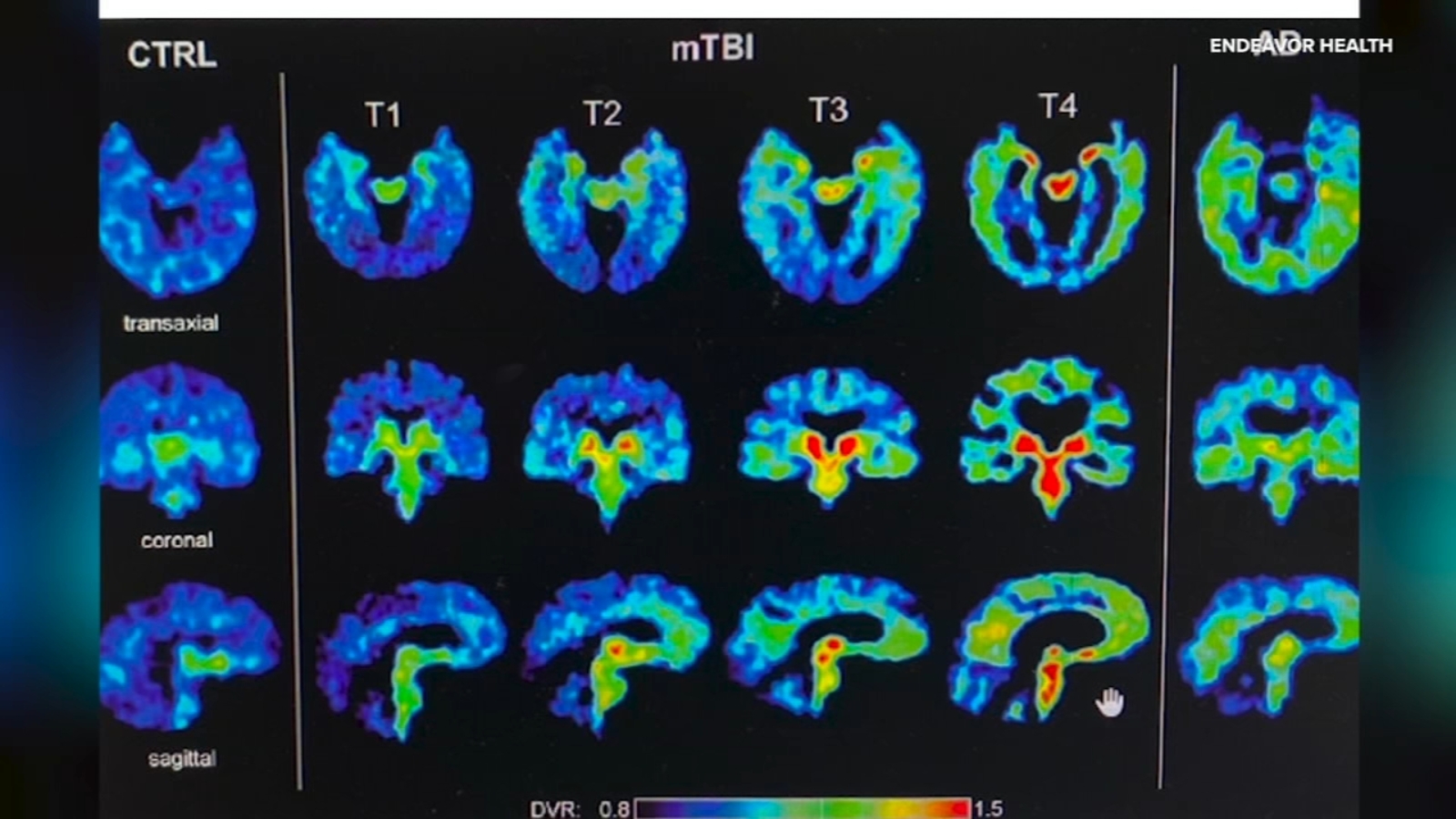 New Research Aims to Diagnose CTE in Living Patients