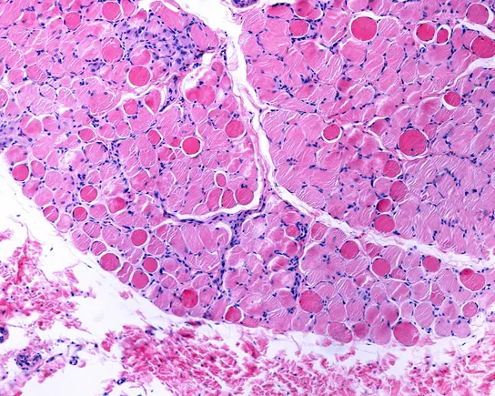 Duchenne Gene Therapy Hits Key Protein Target as FDA Filing Nears