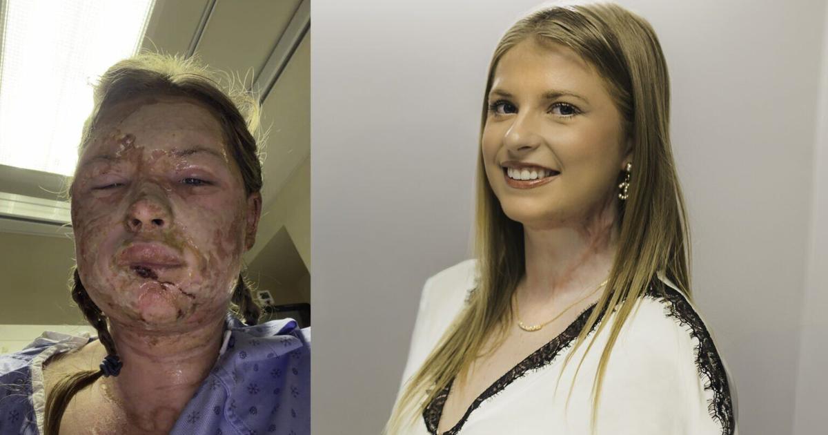 Exosome Injection Heals Severe Facial Burns Without Skin Grafting
