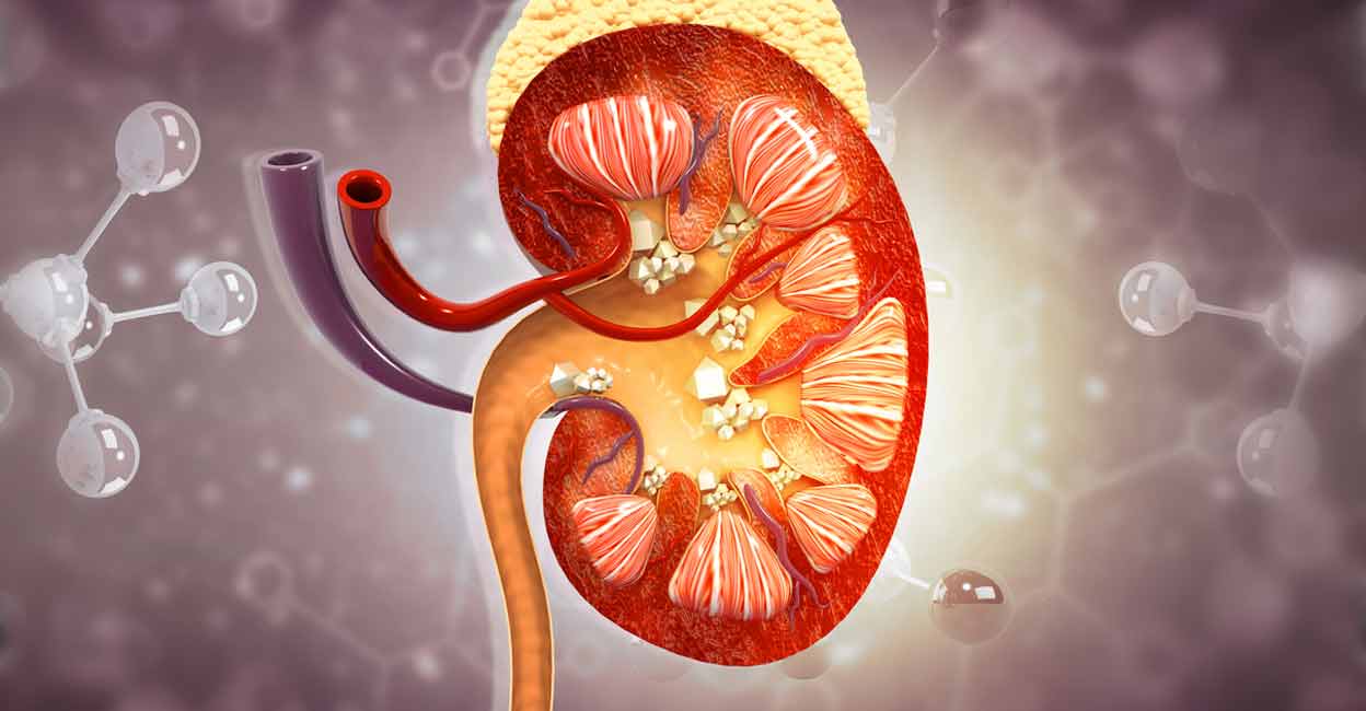 Living Bacteria Found Inside Kidney Stones Revealing New Formation Process