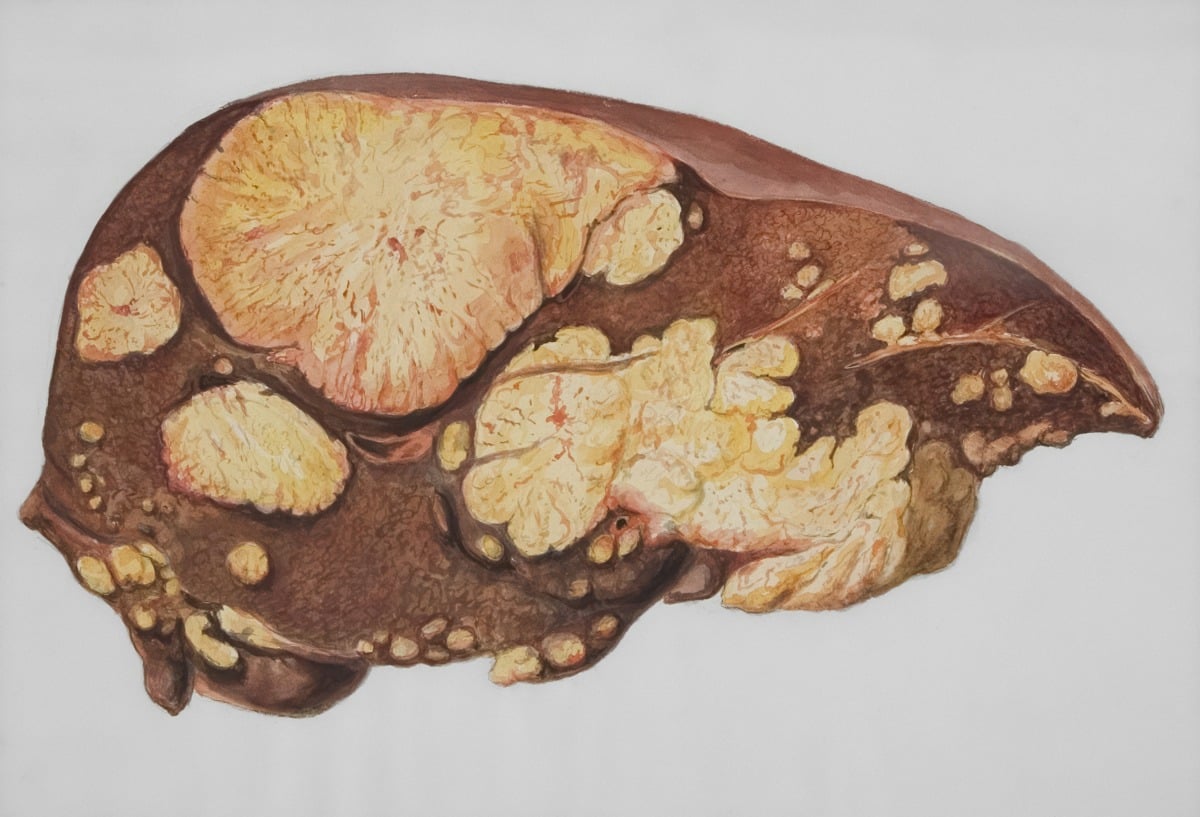 New Hepatitis B Drug Shows Promise in Clinical Trials Toward Functional Cure