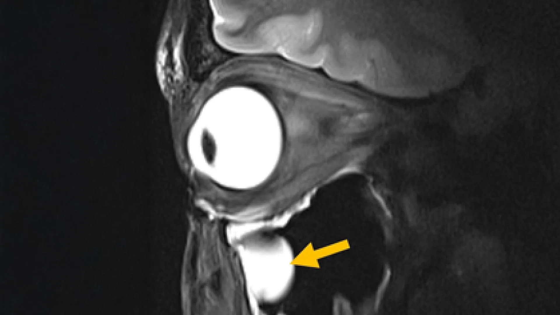 New MRI Antenna Uses Metamaterials to Sharpen Images of Brain and Eye
