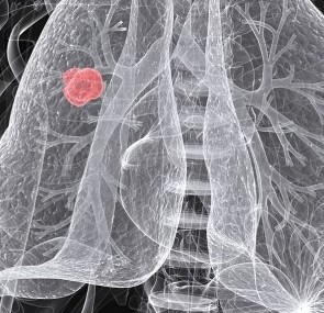 New Nanoparticle Therapy Targets Lung Cancer and Muscle Wasting Simultaneously