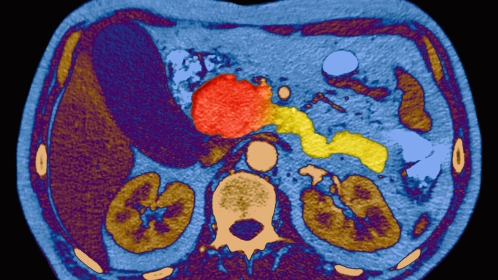 New Pancreatic Cancer Drug Sparks Hope After Decades of Stagnation