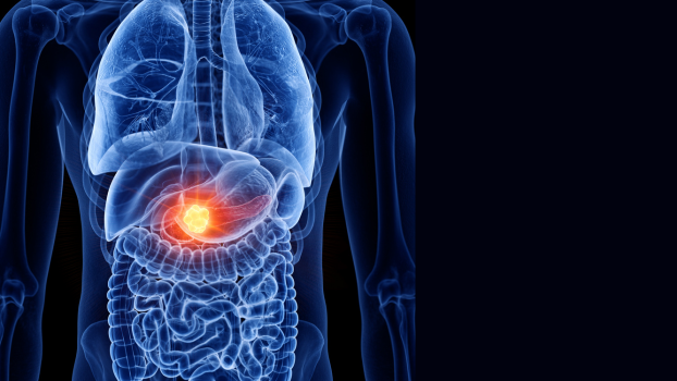 Researchers Identify Key Protein That Fuels Pancreatic Cancer Growth