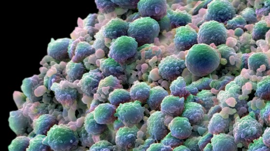 Silica Nanoparticles Kill Prostate Tumors and Revive Immune Response