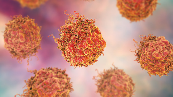 Targeted Radiation Drug Combo Delays Metastatic Prostate Cancer Progression